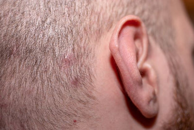 Acne Behind the Ears: Causes, Prevention, and Targeted Solutions