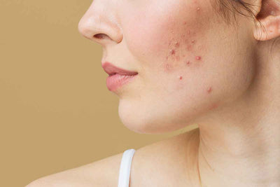 Cheek Acne: Understanding Causes, Prevention, and Treatment